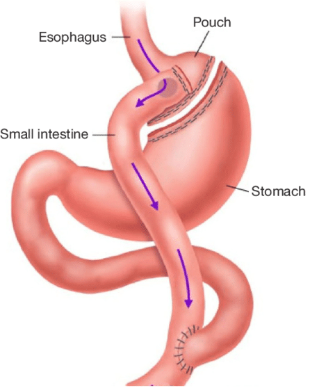 胃バイパスの図。