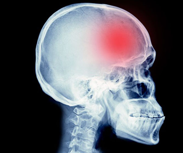 X-ray of skull