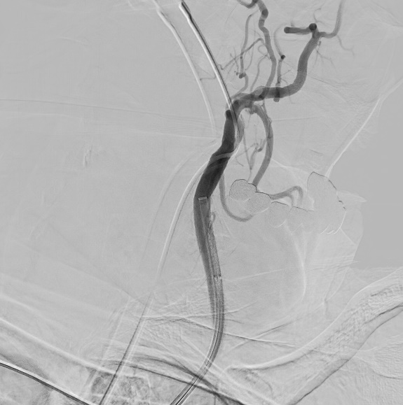 A microscopic photo illustrating carotid artery blockage
