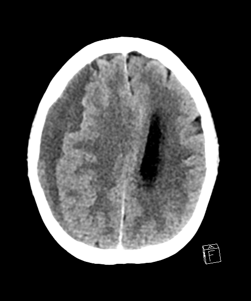 CT Scan print Pre treatment - subdural hematoma