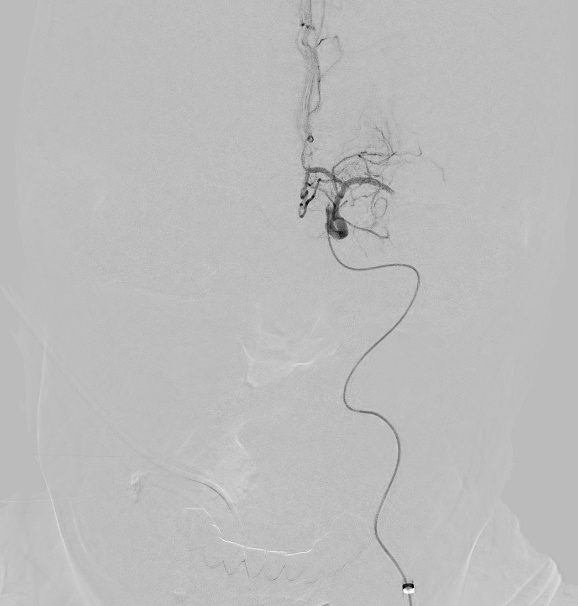 a microscopic photo illustrating left middle cerebral artery clot
