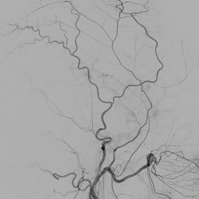 Pre-embolization angiogram