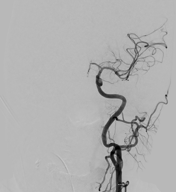 a microscopic photo illustrating stent in carotid artery and clot removed from middle cerebral artery