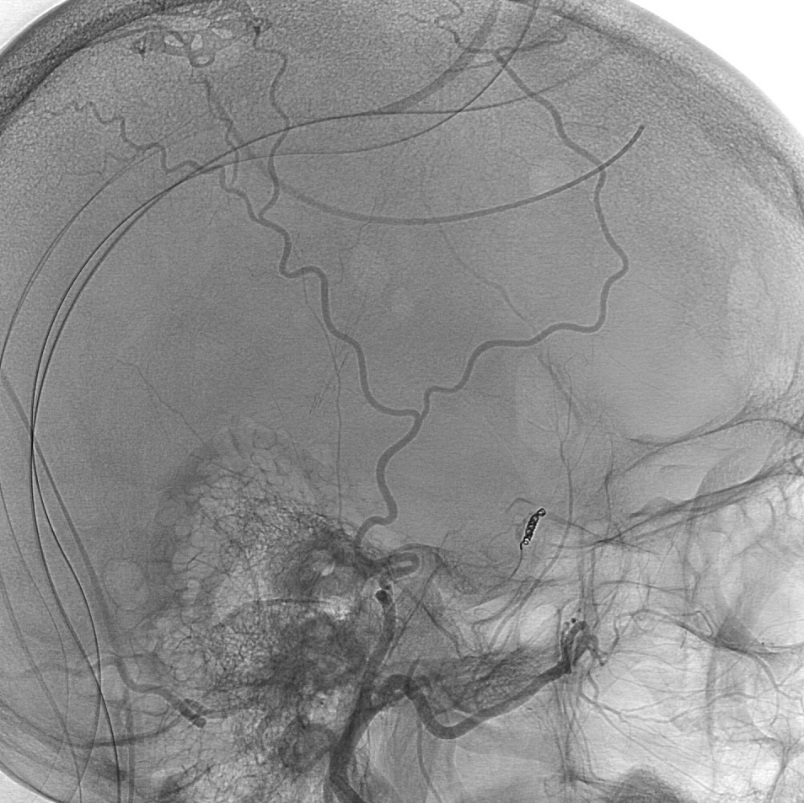 Post embolization angiogram: coil in middle meningeal artery
