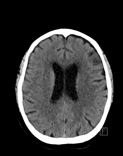 Post treatment CT head: normal
