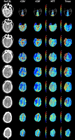 Immagini rappresentative da una lastra di perfusione CT.