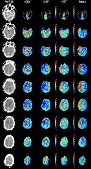 Images représentatives d'une dalle de perfusion CT.