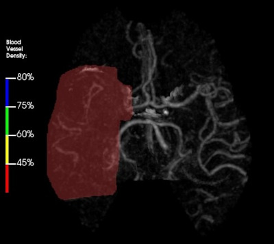 A right middle cerebral artery occlusion.